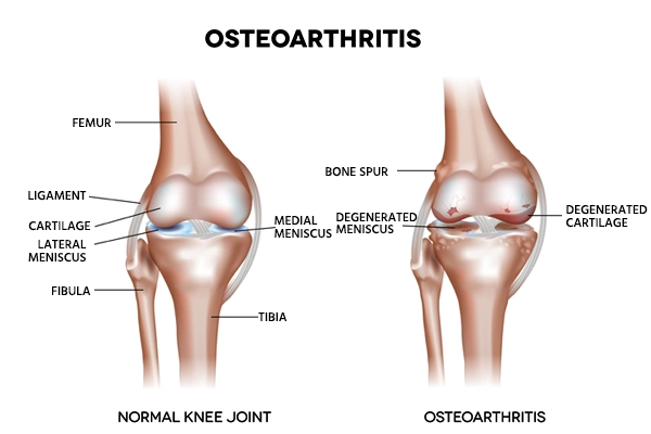 Osteoarthritis क्या है?